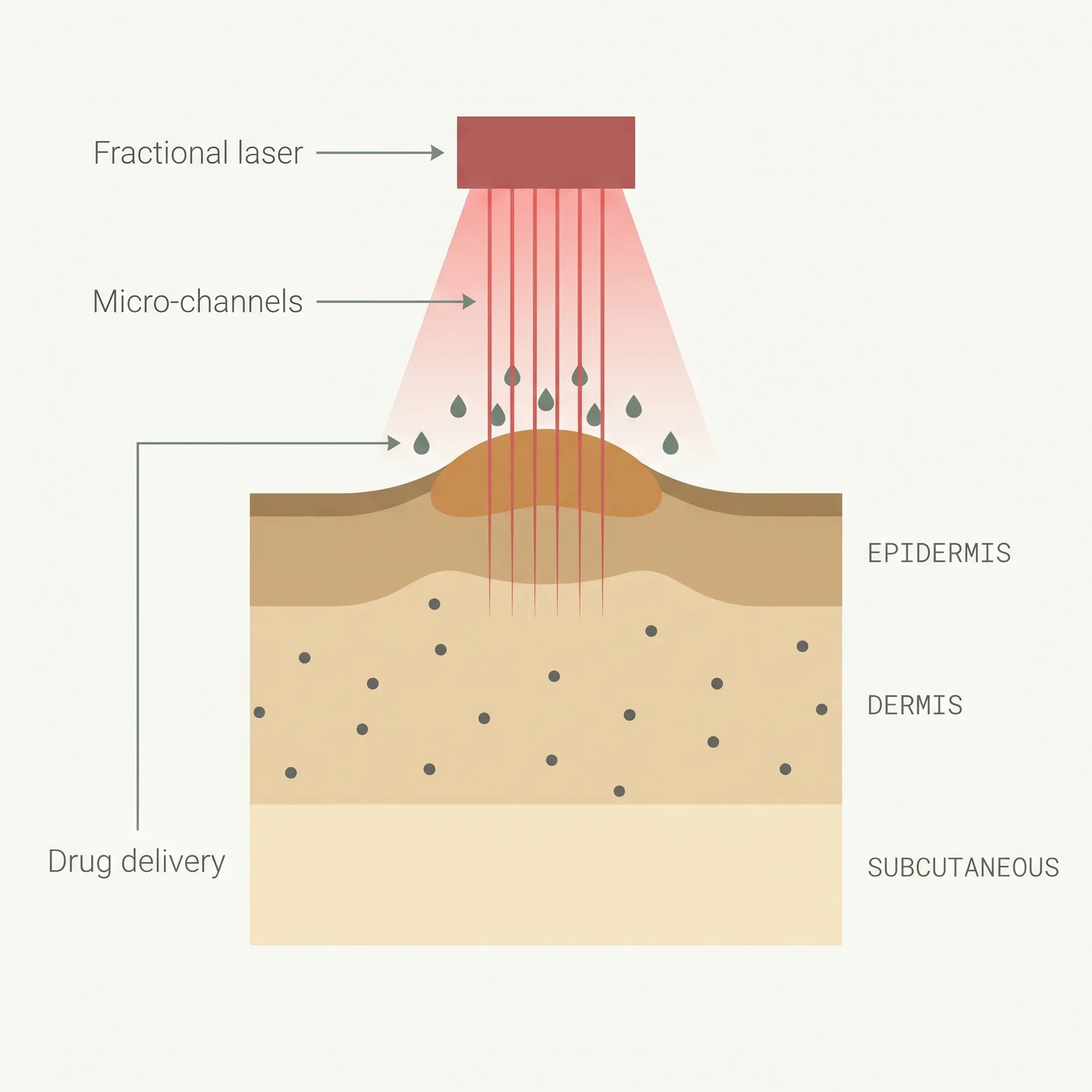 Cross-section with a fractional laser above a raised scar, vertical red micro-channels piercing through the scar surface, and drug droplets entering the channels.