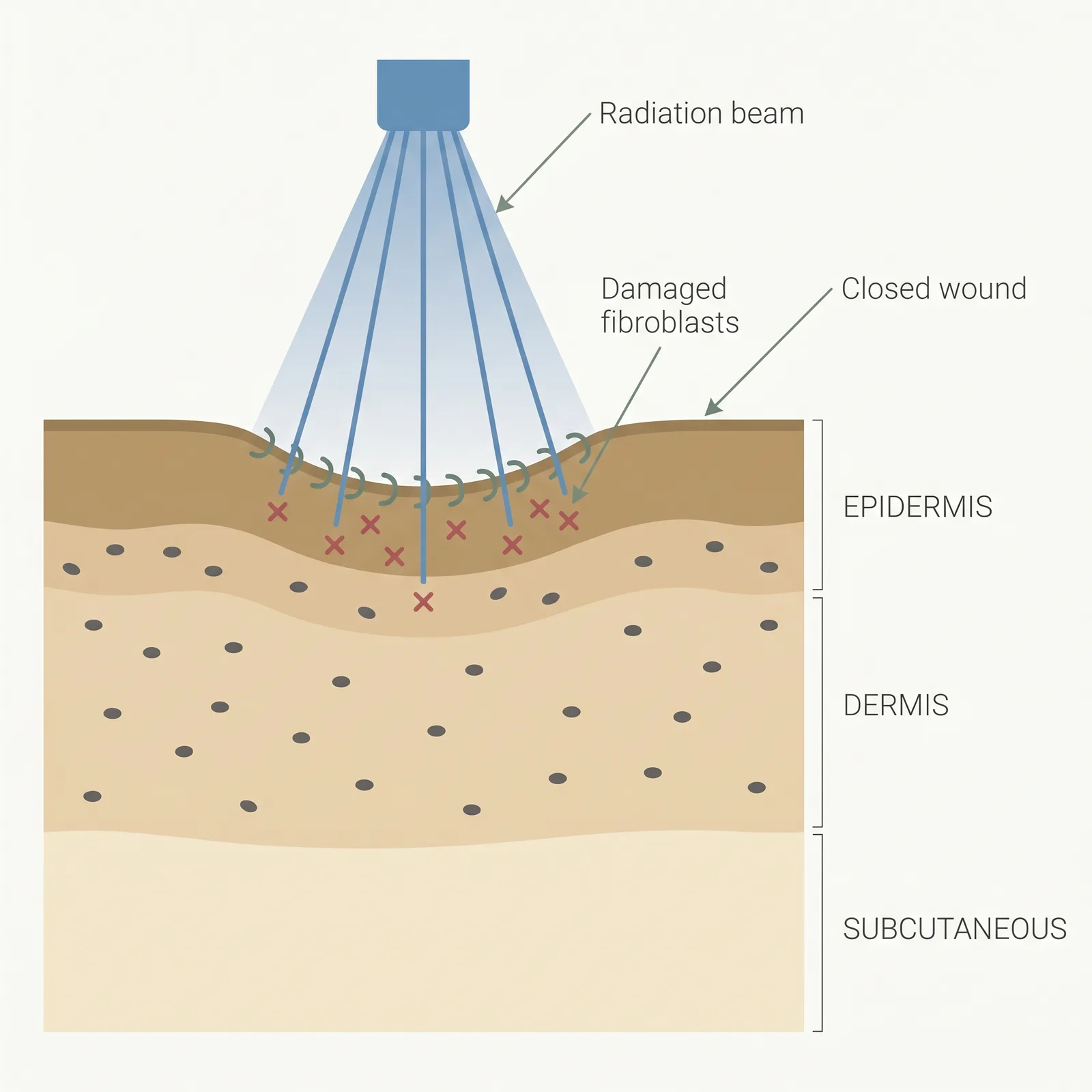 Cross-section showing a post-excision wound with a radiation beam descending onto it and damaged fibroblasts marked with X in the wound bed.