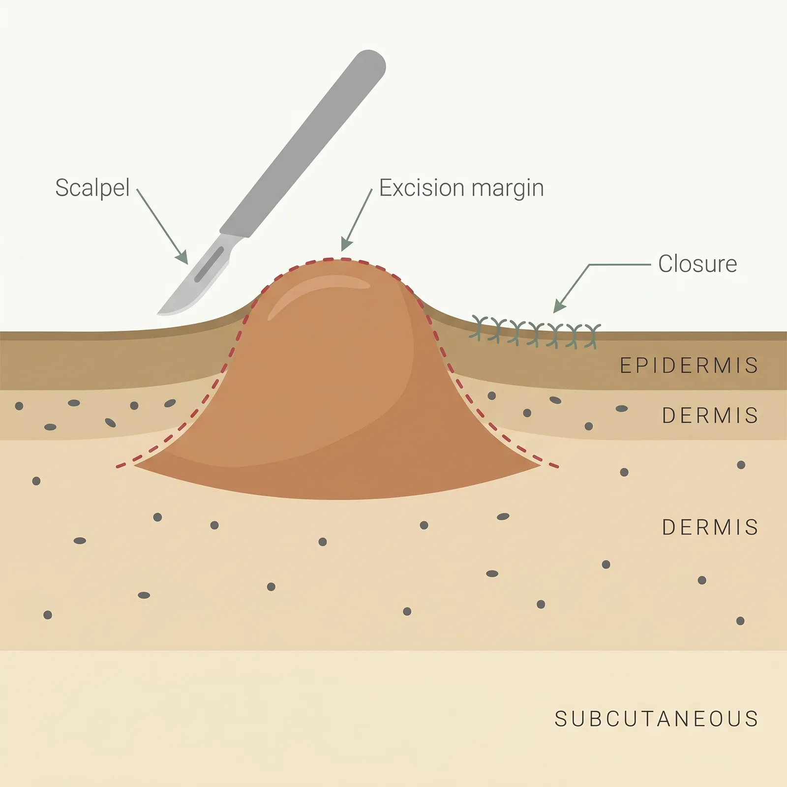 Cross-section showing a keloid with a dashed excision margin around it, a scalpel beside the scar, and a closed suture line.